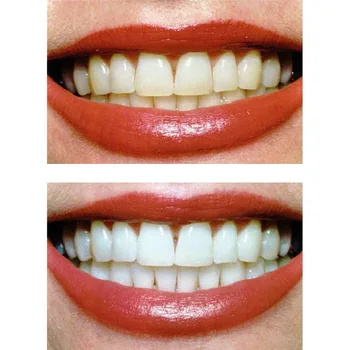 Kvalitné Biele LED Svetlo Zuby, Zubný Gél Whitener Zdravie Starostlivosť o Ústnu dutinu zubná pasta Auta Osobné Zubné Ošetrenie