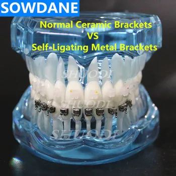 Zubné Ortodontická Model s Keramickou a Self-Ligating Kovové Držiaky na Pacienta Komunikácie