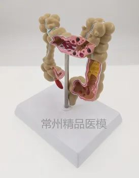 Hrubého čreva patologické modeli Kolorektálneho poškodení črevnej Vzor hrubého čreva, anatómia model vyučovania